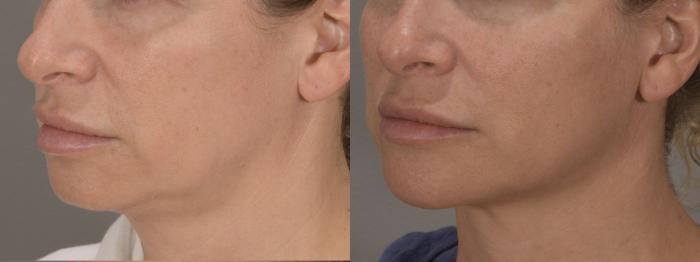 Jawline Filler Case 197 Before & After Left Side | Rochester, NY | Q the Medical Spa