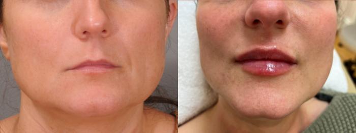 Lip Filler Case 146 Before & After Front | Rochester & Victor, NY | Q the Medical Spa