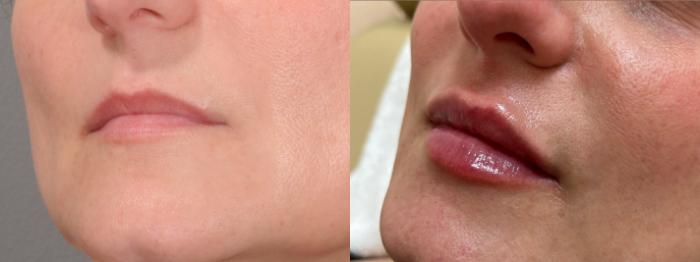 Lip Filler Case 146 Before & After Left Oblique | Rochester & Victor, NY | Q the Medical Spa