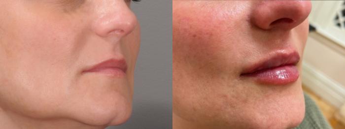 Lip Filler Case 146 Before & After Right Oblique | Rochester & Victor, NY | Q the Medical Spa