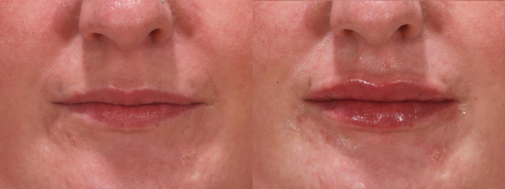 Lip Filler Case 147 Before & After Front | Rochester & Victor, NY | Q the Medical Spa