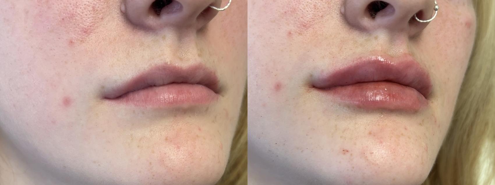Lip Filler Case 152 Before & After Front | Rochester, NY | Q the Medical Spa