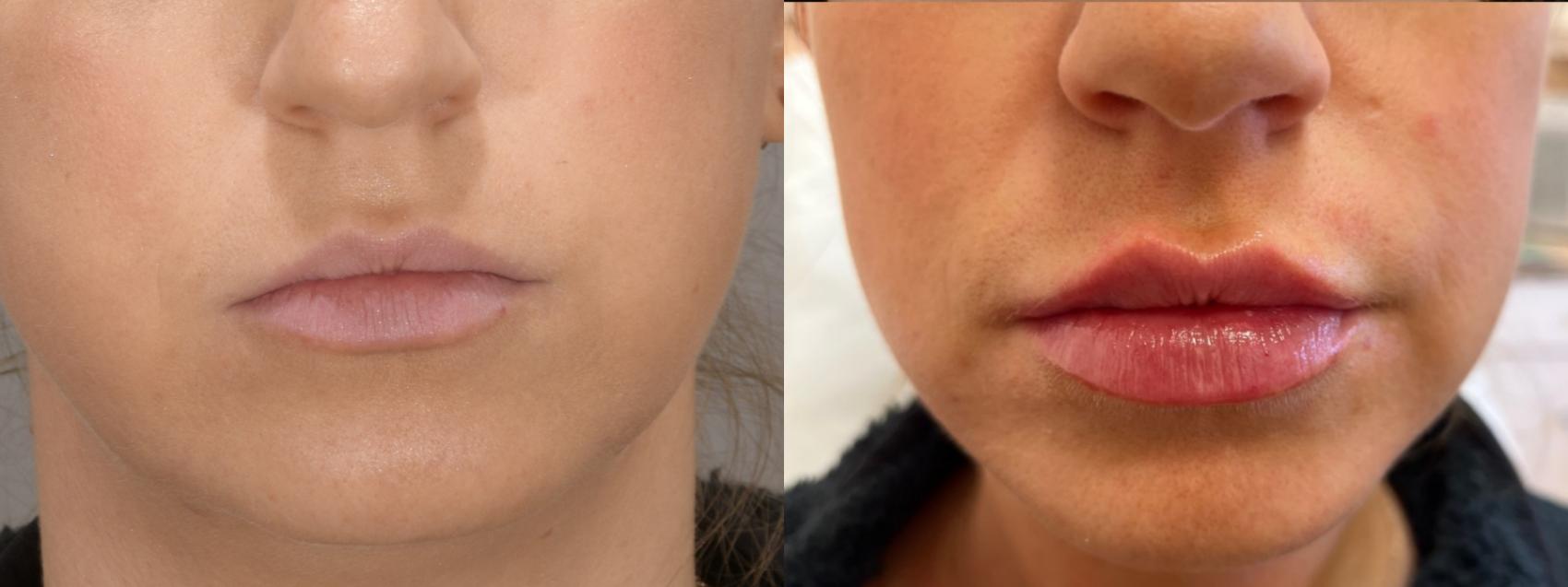 Lip Filler Case 154 Before & After Front | Rochester & Victor, NY | Q the Medical Spa