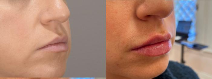Lip Filler Case 154 Before & After Right Oblique | Rochester & Victor, NY | Q the Medical Spa