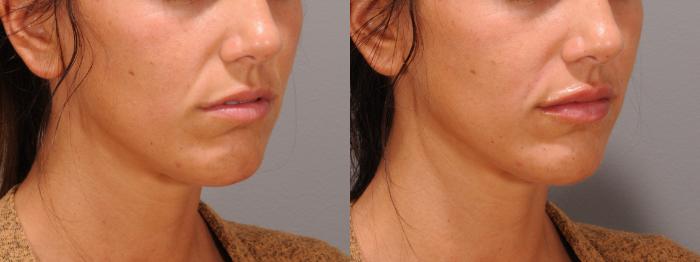 Lip Filler Case 178 Before & After Right Oblique | Rochester & Victor, NY | Q the Medical Spa