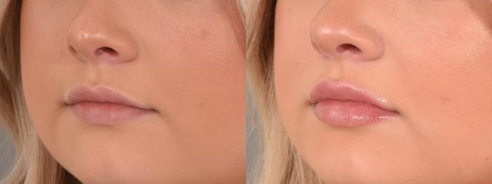 Lip Filler Case 181 Before & After Left Oblique | Rochester & Victor, NY | Q the Medical Spa
