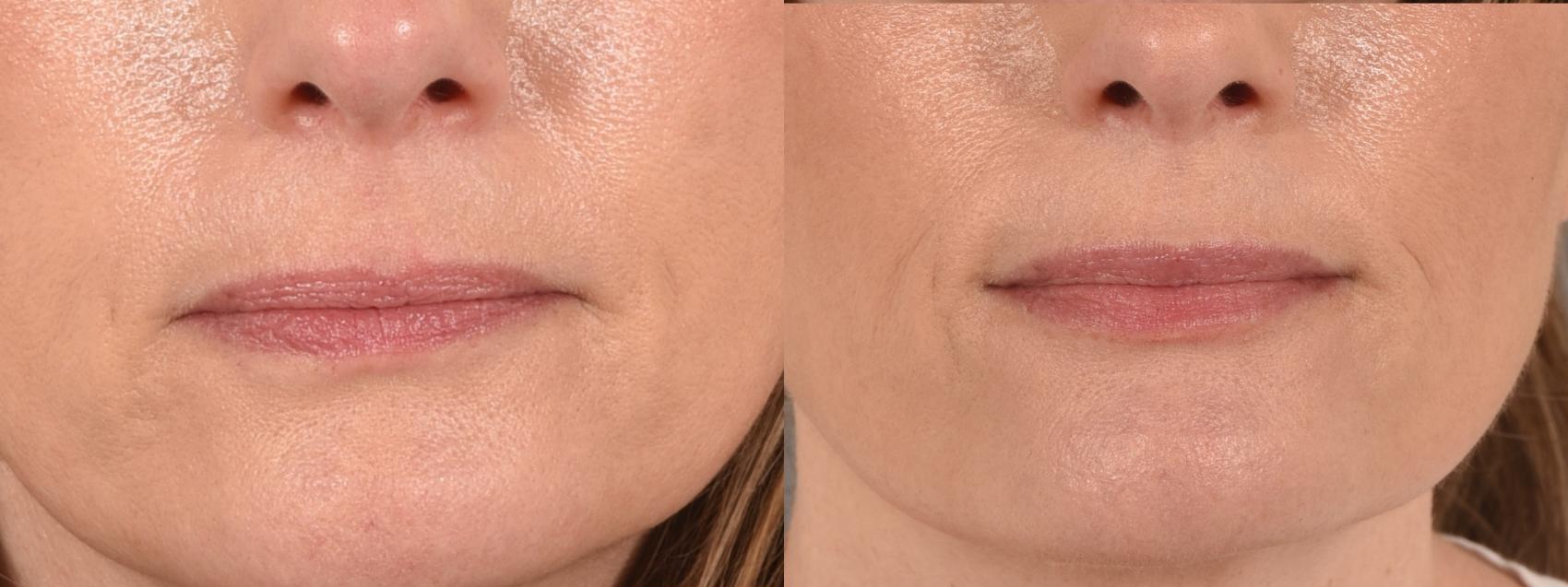 Lip Filler Case 183 Before & After Front | Rochester & Victor, NY | Q the Medical Spa