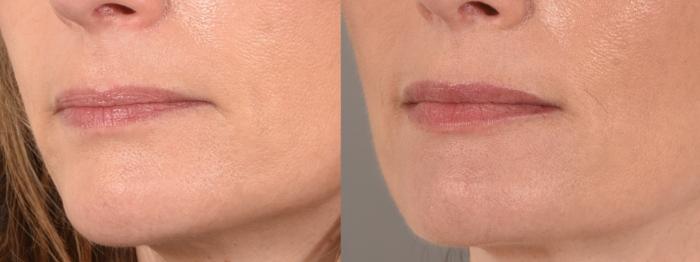 Lip Filler Case 183 Before & After Left Oblique | Rochester & Victor, NY | Q the Medical Spa