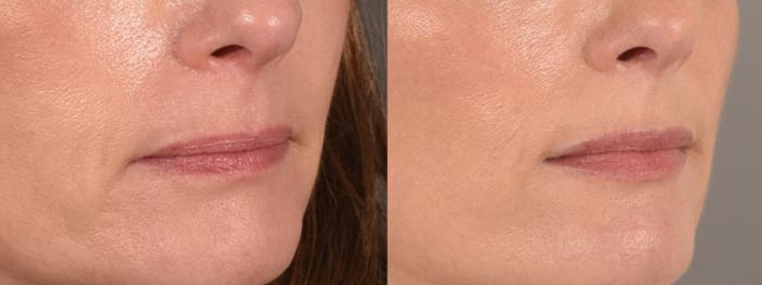 Lip Filler Case 183 Before & After Right Oblique | Rochester & Victor, NY | Q the Medical Spa