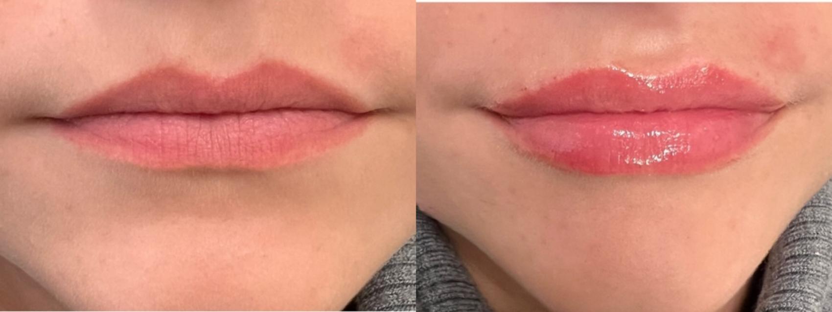 Lip Filler Case 184 Before & After Front | Rochester & Victor, NY | Q the Medical Spa