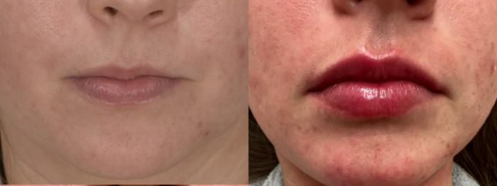 Lip Filler Case 188 Before & After Front | Rochester & Victor, NY | Q the Medical Spa