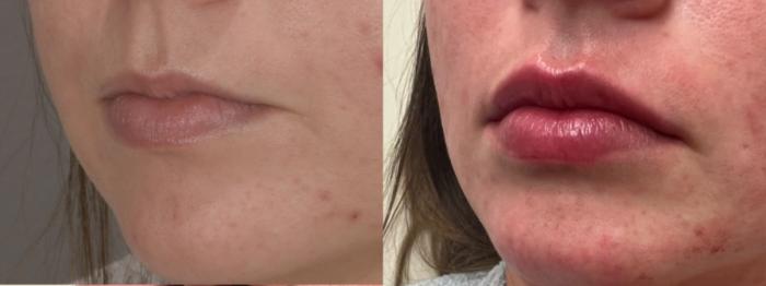 Lip Filler Case 188 Before & After Left Oblique | Rochester & Victor, NY | Q the Medical Spa