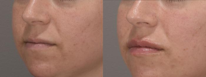 Lip Filler Case 190 Before & After Left Oblique | Rochester & Victor, NY | Q the Medical Spa
