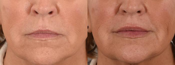 Lip Filler Case 241 Before & After Front | Rochester, NY | Q the Medical Spa