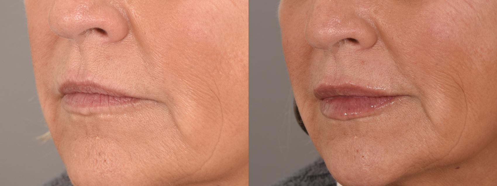 Lip Filler Case 241 Before & After Left Oblique | Rochester, NY | Q the Medical Spa
