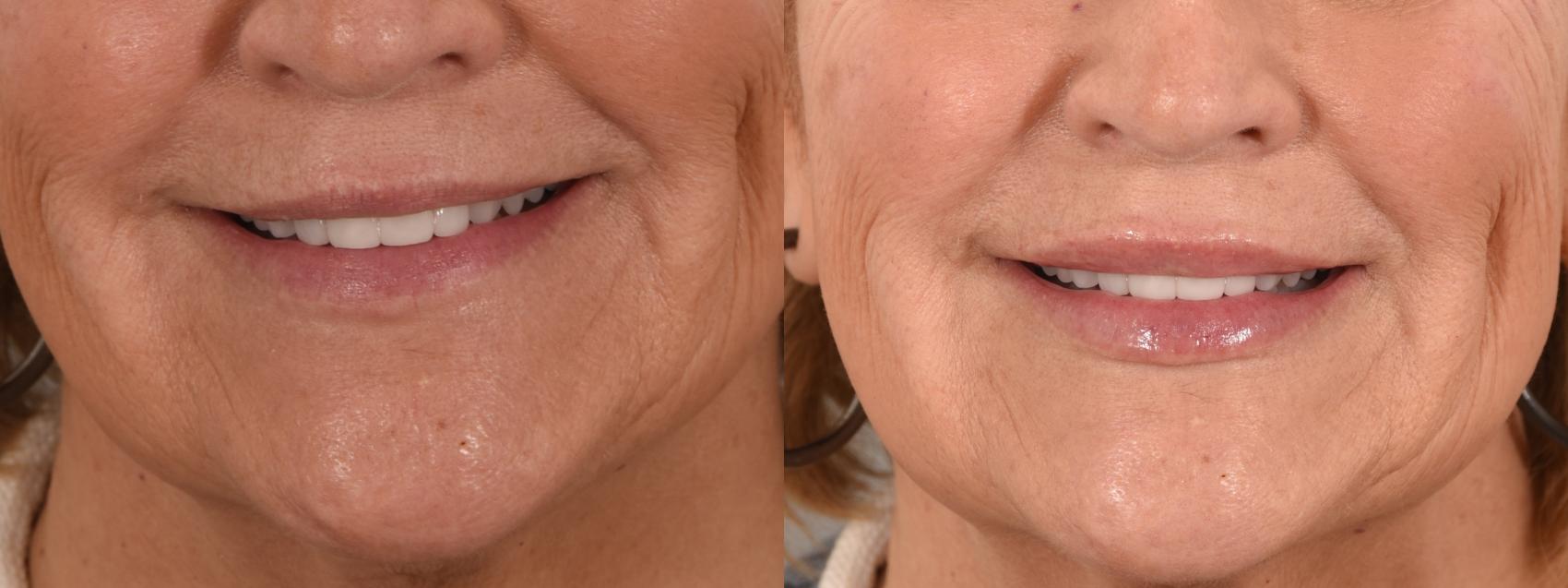 Lip Filler Case 241 Before & After Smile | Rochester, NY | Q the Medical Spa