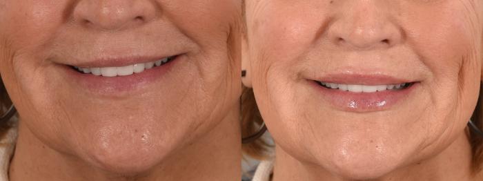 Lip Filler Case 241 Before & After Smile | Rochester, NY | Q the Medical Spa