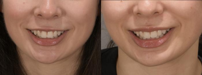 Lip Flip/Gummy Smile Case 236 Before & After Front | Rochester, NY | Q the Medical Spa