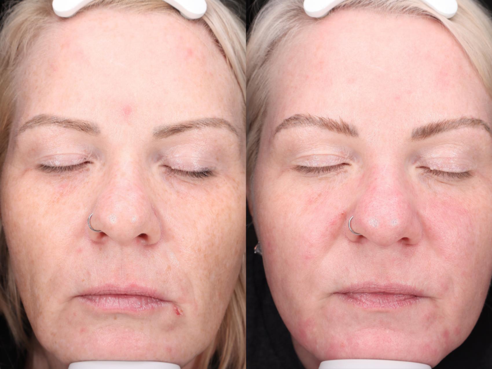 Moxi Case 200 Before & After Front | Rochester, NY | Q the Medical Spa