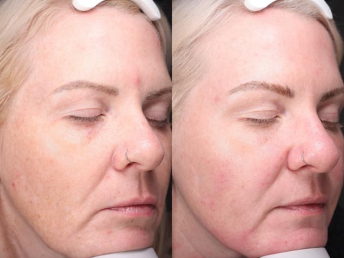 Moxi Case 200 Before & After Left Oblique | Rochester & Victor, NY | Q the Medical Spa