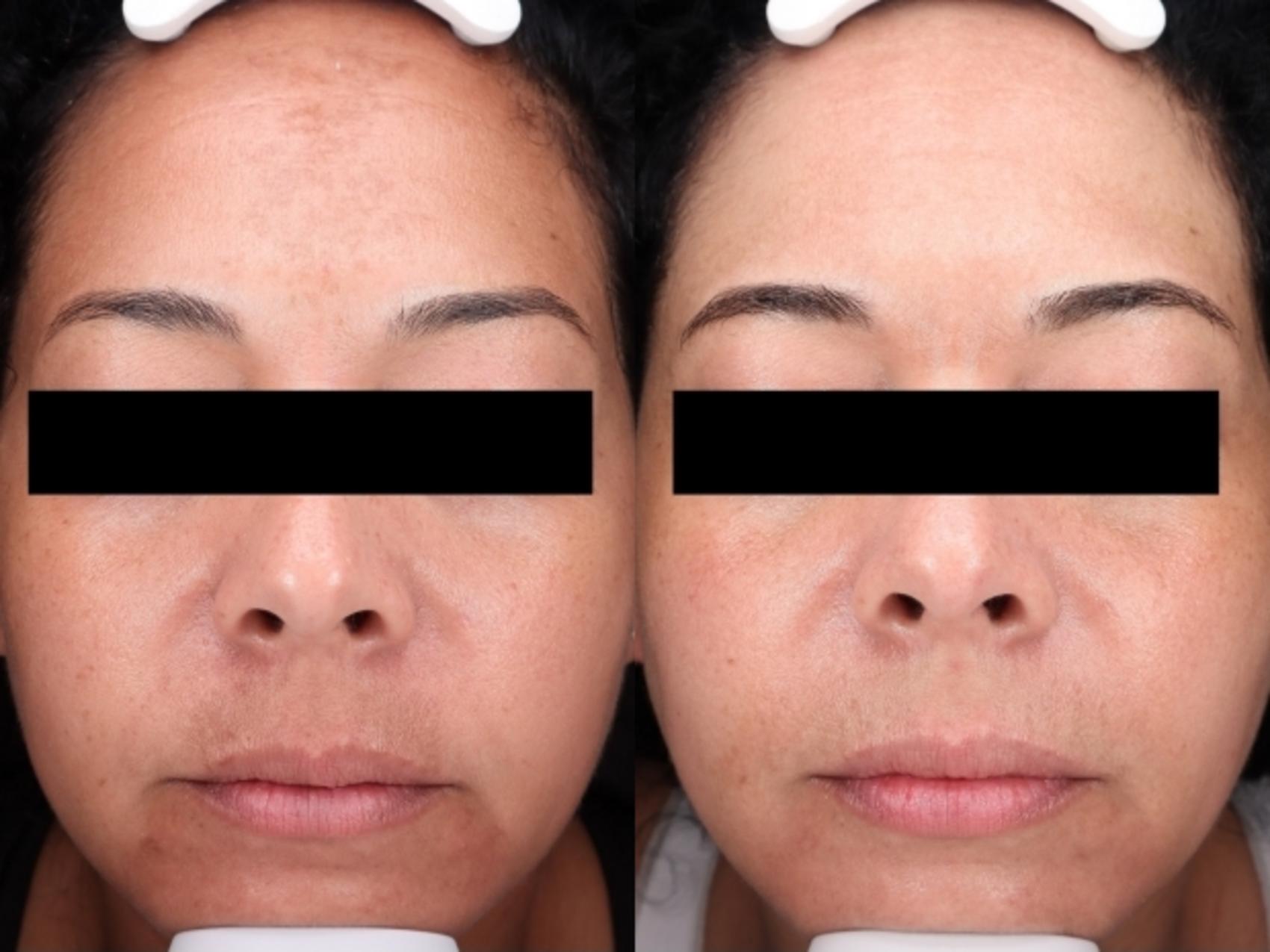 Moxi Case 203 Before & After Front | Rochester, NY | Q the Medical Spa