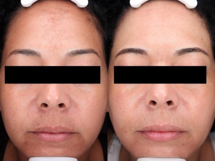 Moxi Case 203 Before & After Front | Rochester & Victor, NY | Q the Medical Spa