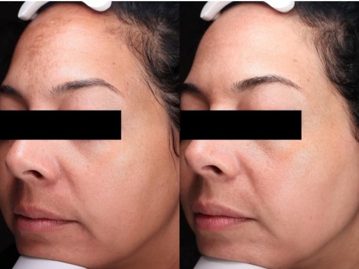 Moxi Case 203 Before & After Left Oblique | Rochester & Victor, NY | Q the Medical Spa