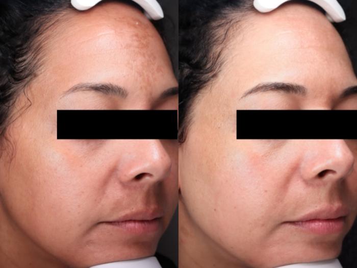 Moxi Case 203 Before & After Right Oblique | Rochester & Victor, NY | Q the Medical Spa