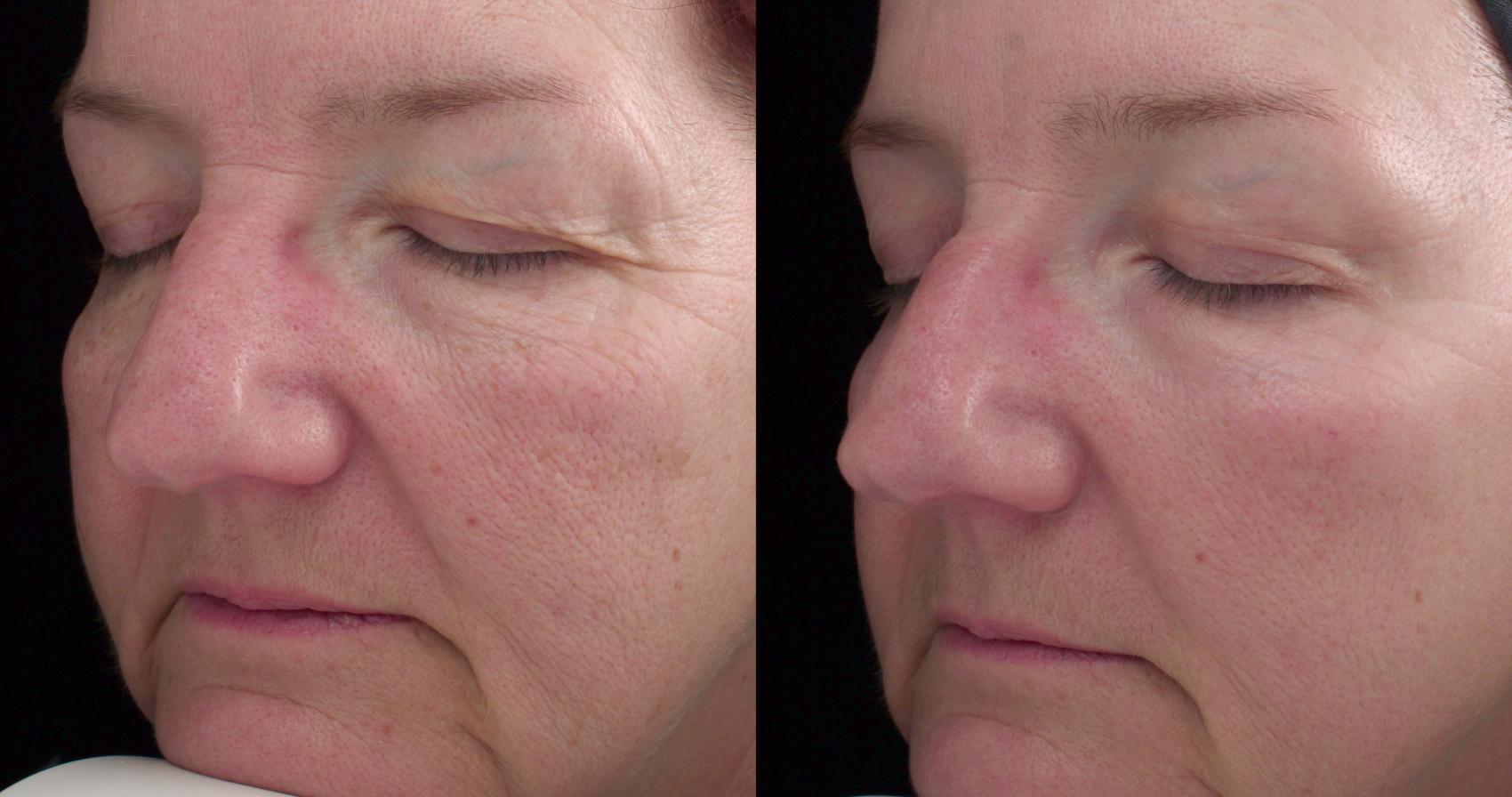 Peels and Microdermabrasion Case 50 Before & After View #1 | Rochester, NY | Q the Medical Spa