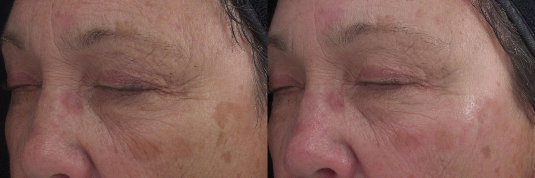 Peels and Microdermabrasion Case 56 Before & After View #1 | Rochester, NY | Q the Medical Spa