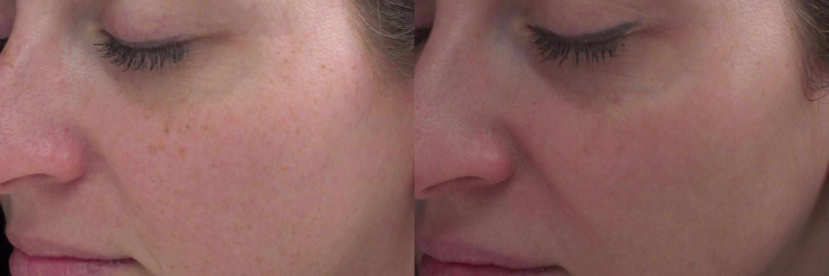Peels and Microdermabrasion Case 58 Before & After View #1 | Rochester, NY | Q the Medical Spa
