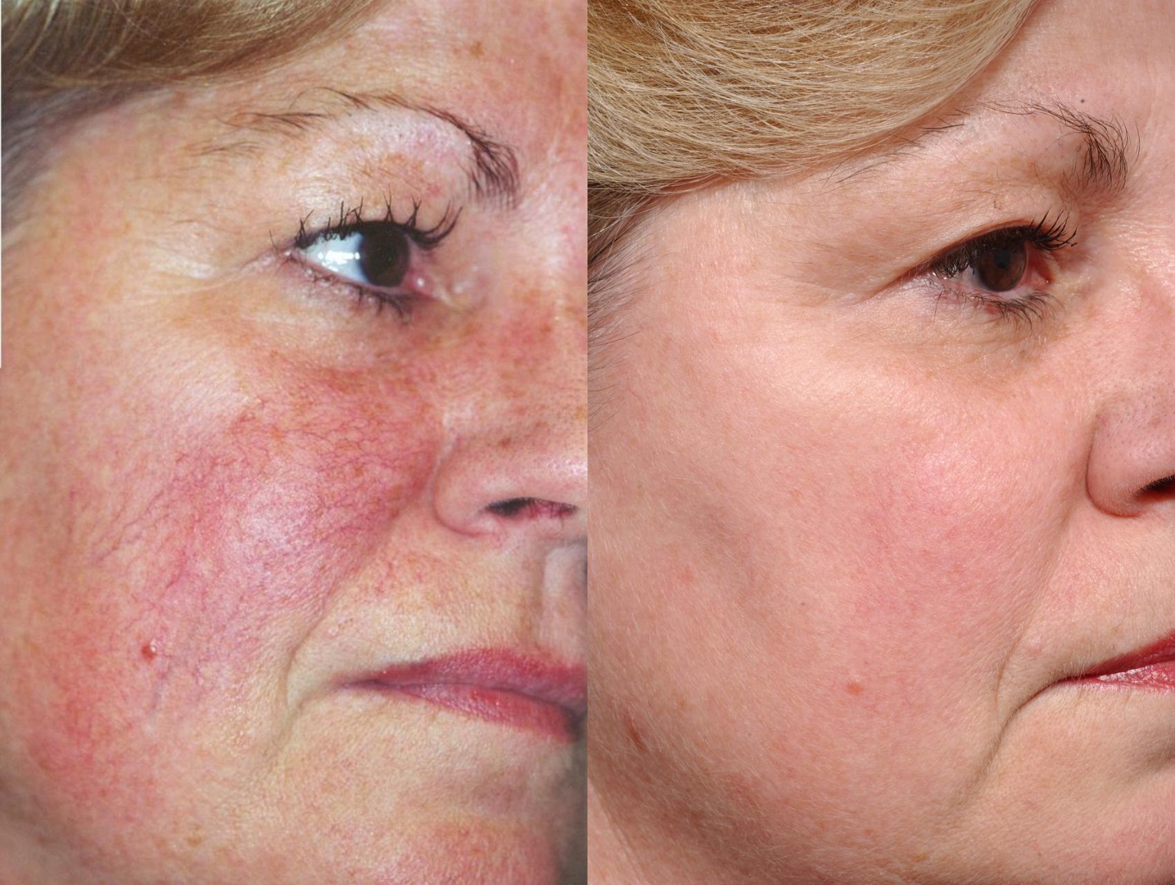 Photorejuvenation Case 34 Before & After View #1 | Rochester, NY | Q the Medical Spa