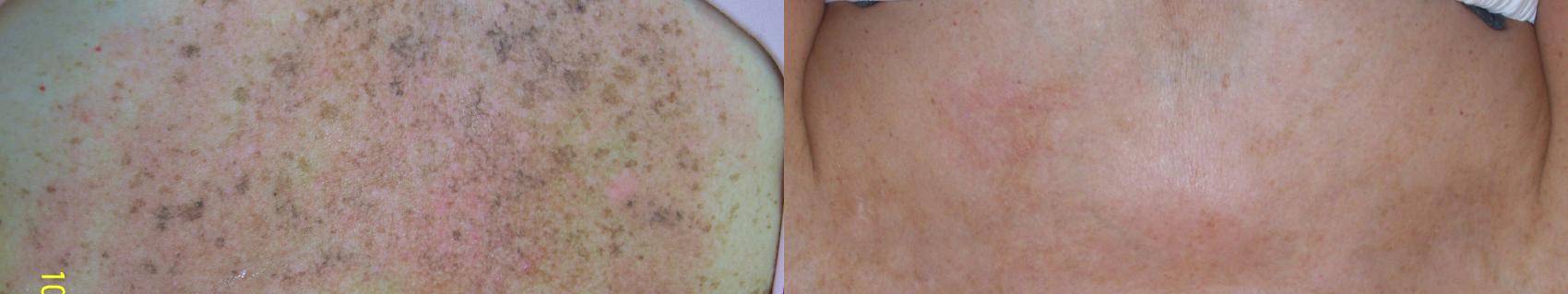 Photorejuvenation Case 38 Before & After View #1 | Rochester, NY | Q the Medical Spa