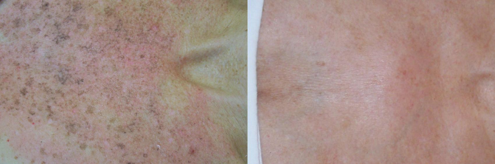 Photorejuvenation Case 38 Before & After View #2 | Rochester, NY | Q the Medical Spa