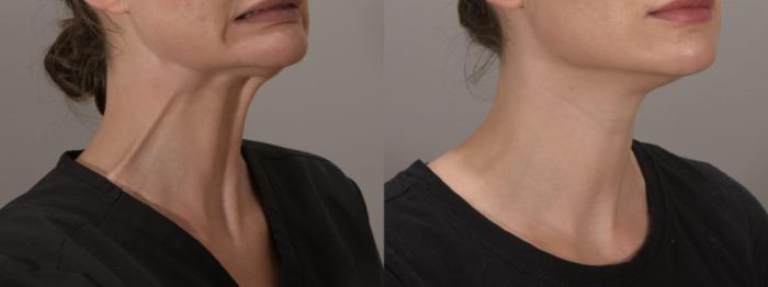 Platysma Bands Case 175 Before & After Left Oblique | Rochester, NY | Q the Medical Spa