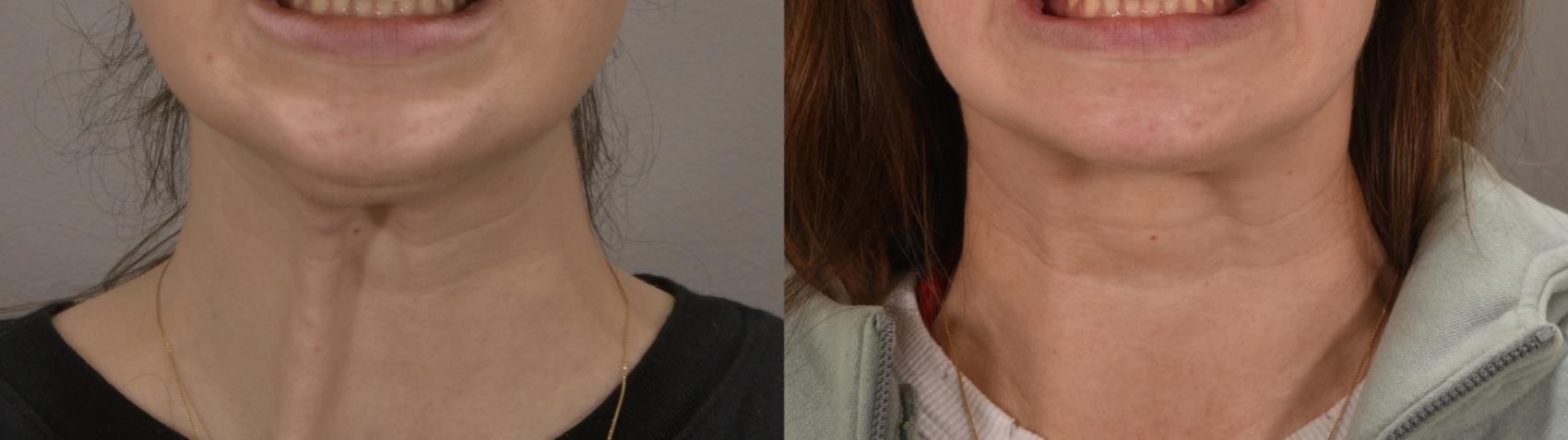 Platysma Bands Case 227 Before & After Front | Rochester, NY | Q the Medical Spa