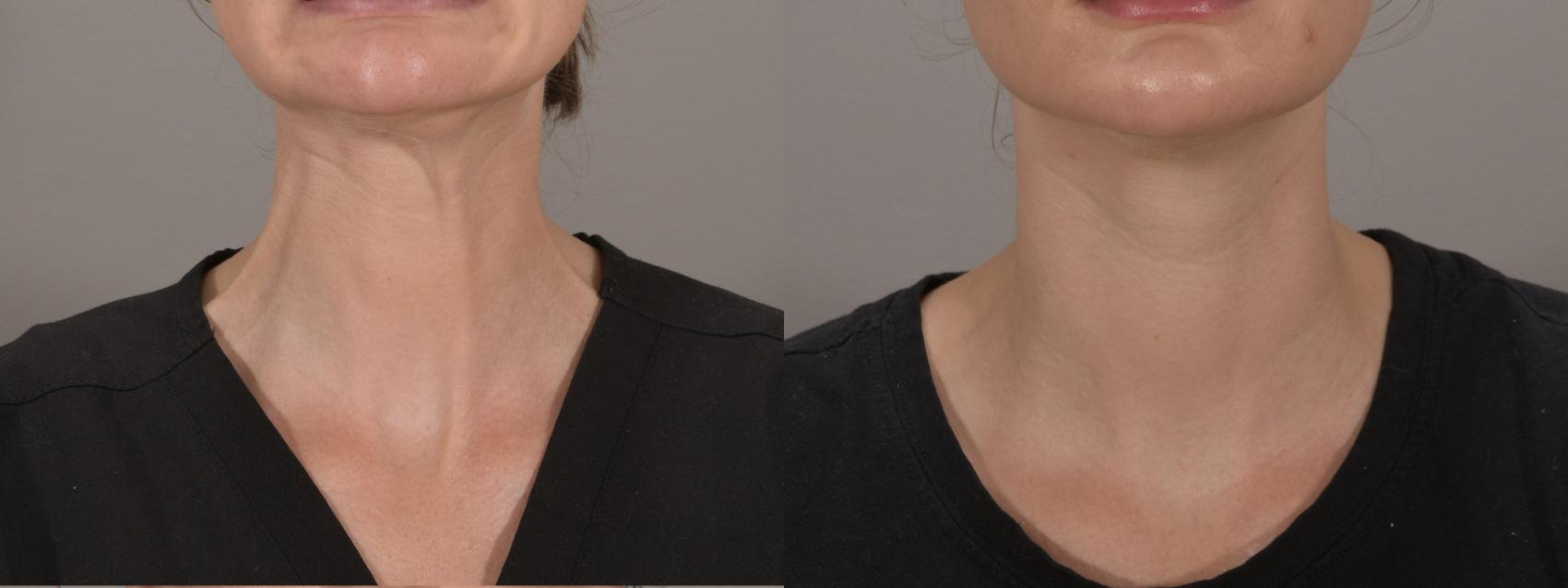 Lower Face Botox (DAO, Chin) Case 175 Before & After Front | Rochester, NY | Q the Medical Spa