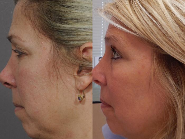 Skin Resurfacing Case 33 Before & After View #2 | Rochester & Victor, NY | Q the Medical Spa