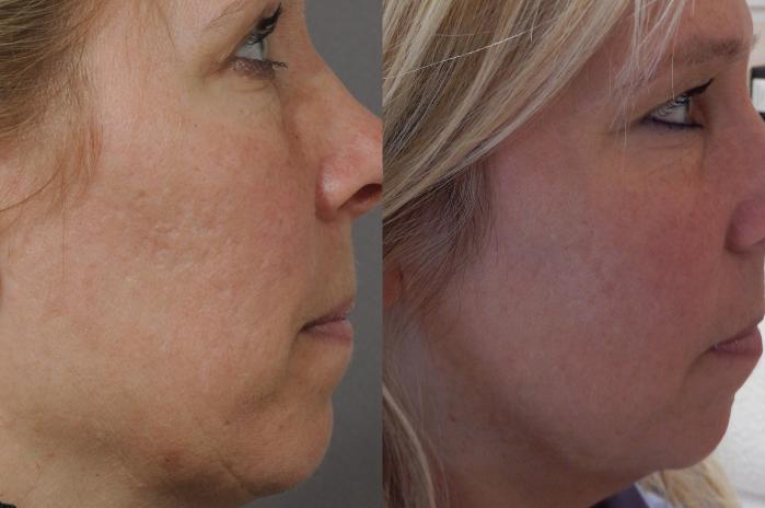 Skin Resurfacing Case 33 Before & After View #4 | Rochester & Victor, NY | Q the Medical Spa