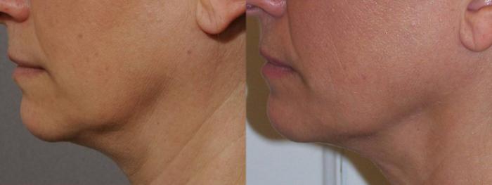 Ultherapy® Case 43 Before & After View #1 | Rochester & Victor, NY | Q the Medical Spa
