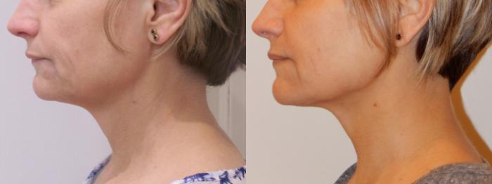 Ultherapy® Case 44 Before & After View #1 | Rochester & Victor, NY | Q the Medical Spa