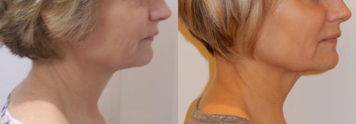 Ultherapy® Case 44 Before & After View #2 | Rochester & Victor, NY | Q the Medical Spa