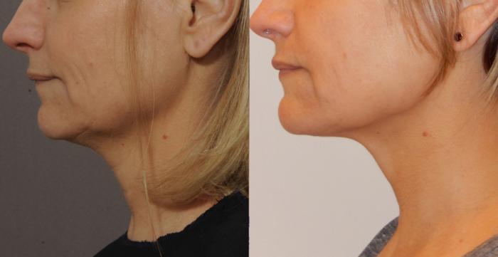 Ultherapy® Case 44 Before & After View #3 | Rochester & Victor, NY | Q the Medical Spa